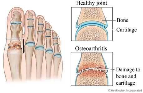 Osteoarthritis of the foot