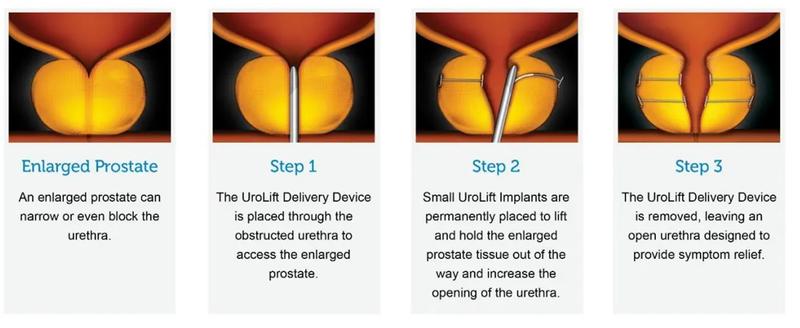 urolift description